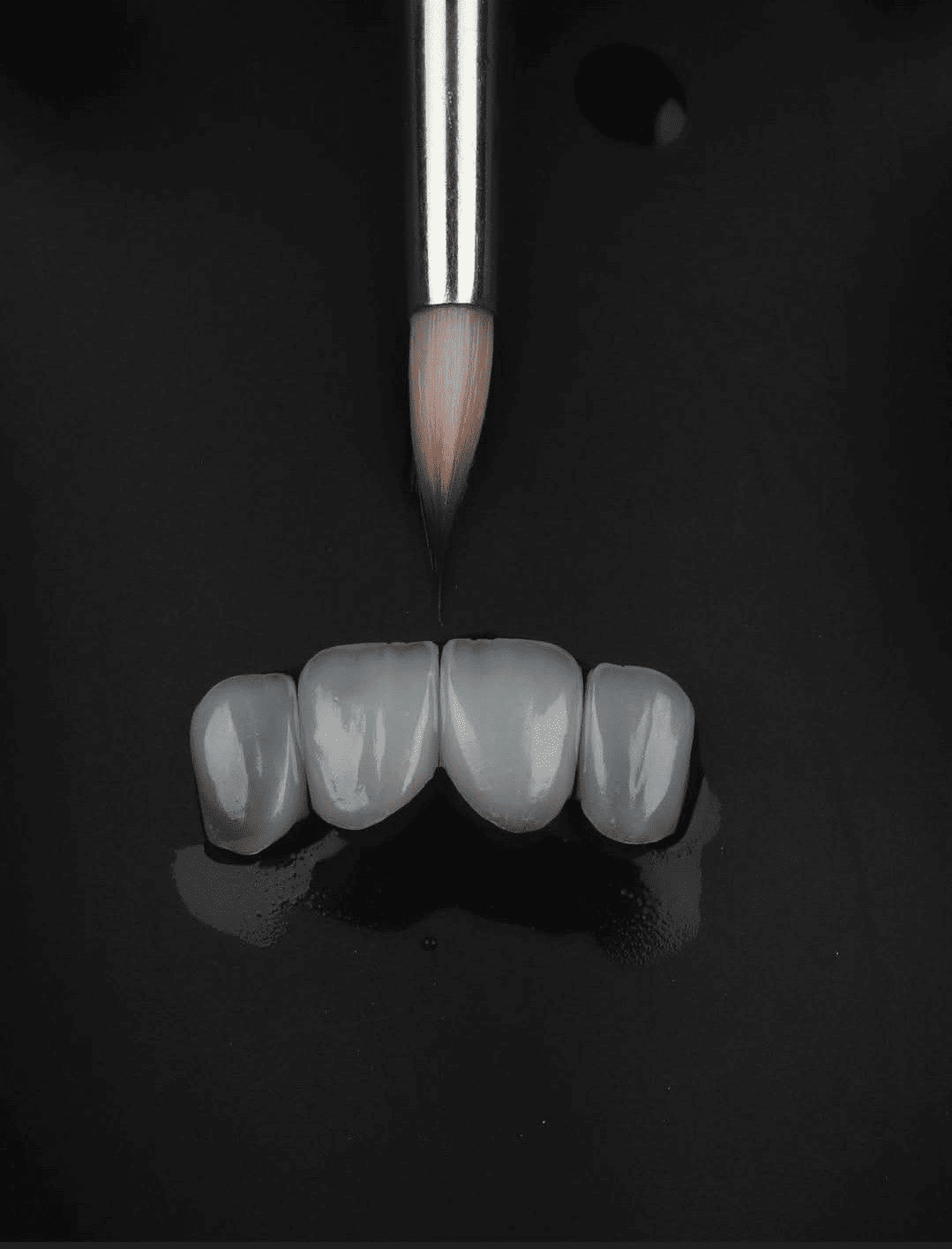 Illustration de facettes dentaires sur les dents antérieures