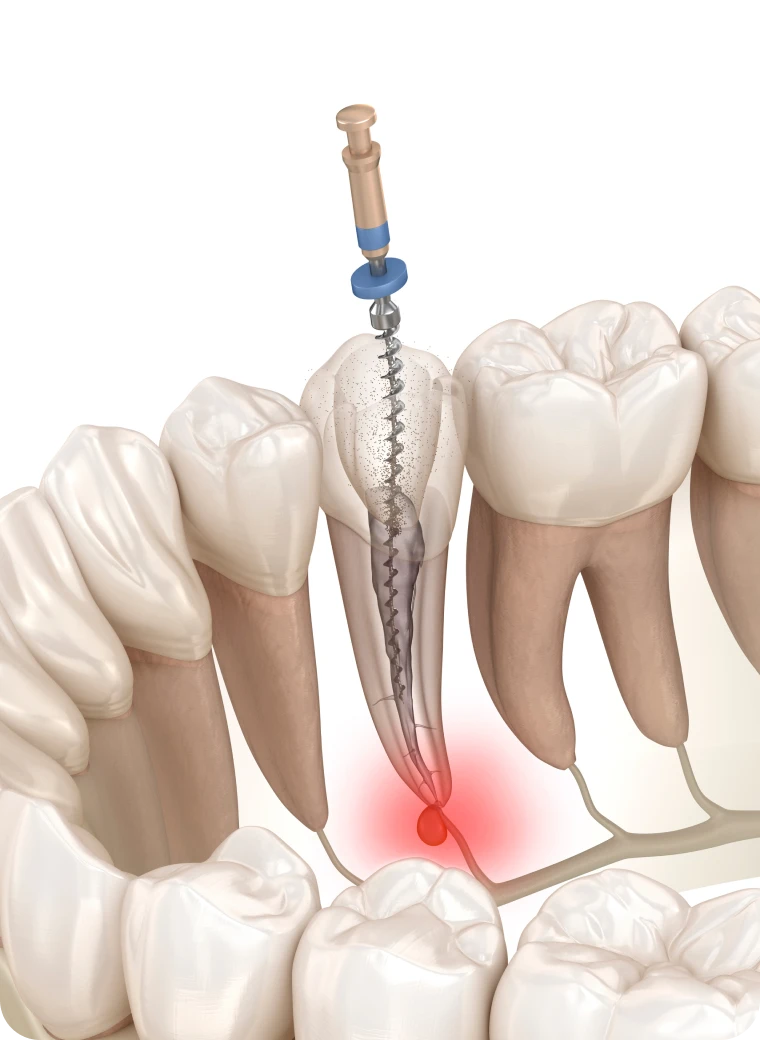 Illustration d'un retraitement endodontique