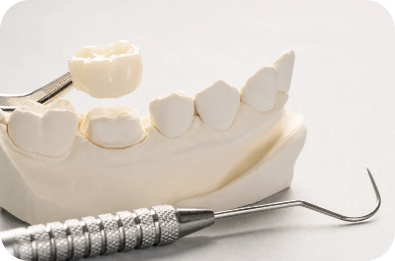 Couronne dentaire sur moulage avant pose