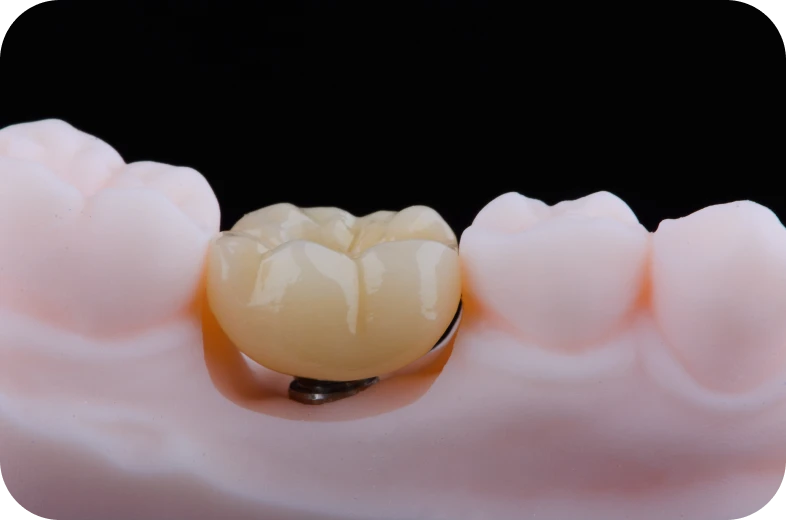 Couronne sur implant