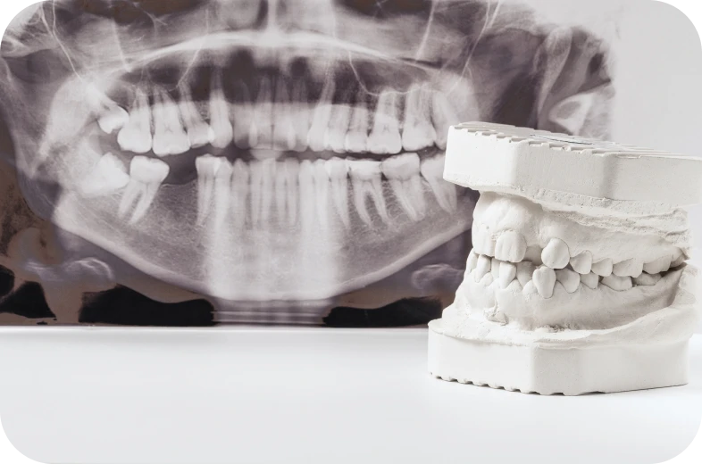 Radiographie pour évaluer un canal minéralisé