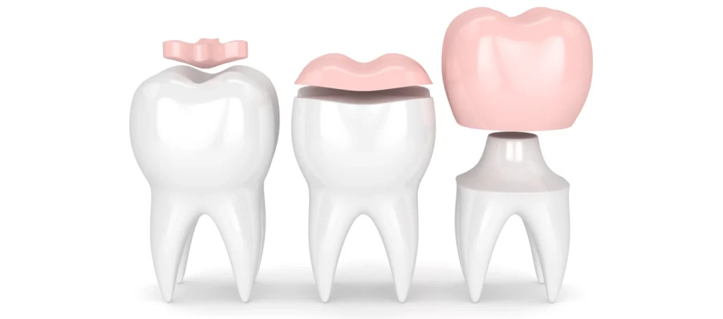 Comparaison entre inlay, onlay et couronne dentaire