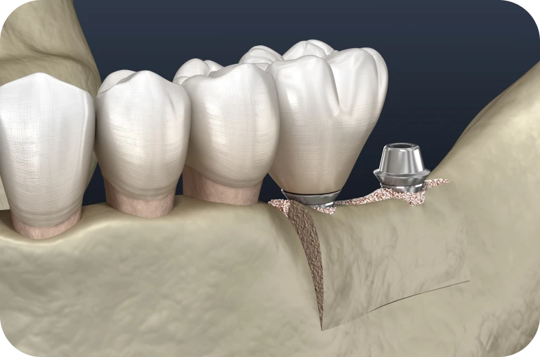 Implant dentaire posé après un soulevé de sinus